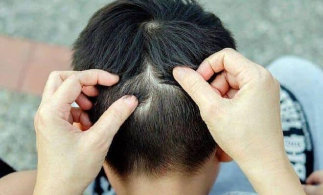 Comment tuer les poux naturellement